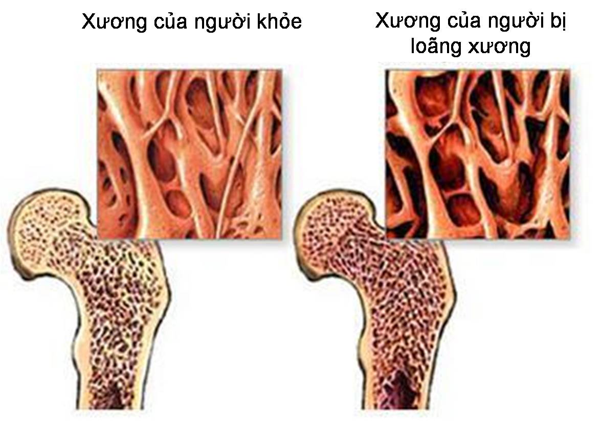 Nước ion kiềm trị bệnh loãng xương