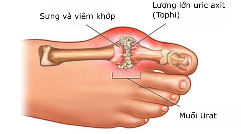 Chữa bệnh gout bằng việc sử dụng nước ion kiềm