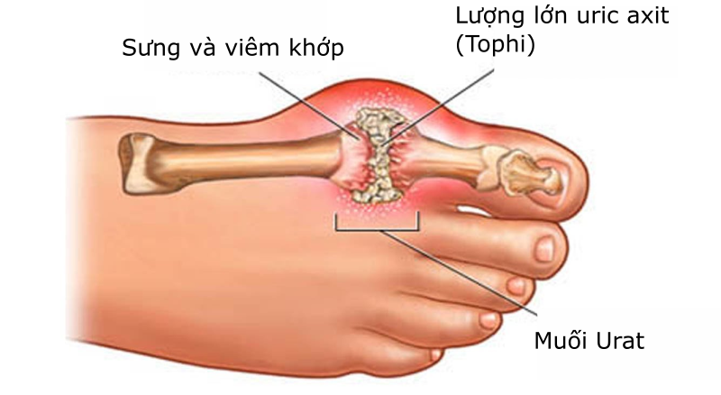 Chữa bệnh gout bằng việc sử dụng nước ion kiềm